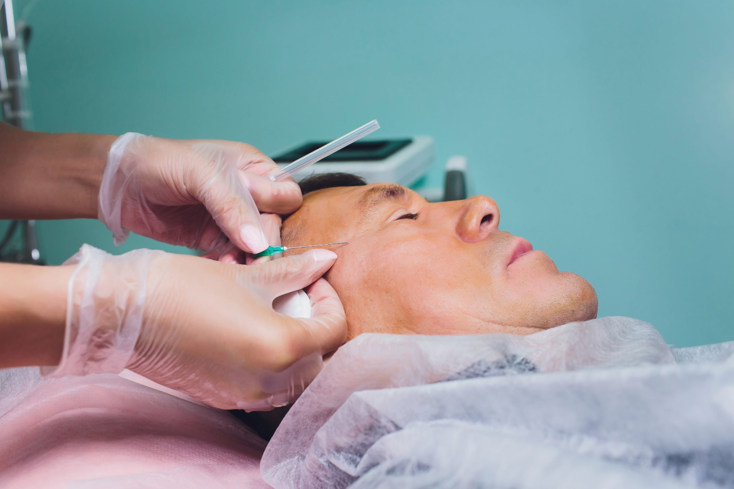 Foto de um homem realizando um procedimento estético chamado Fios de PDO