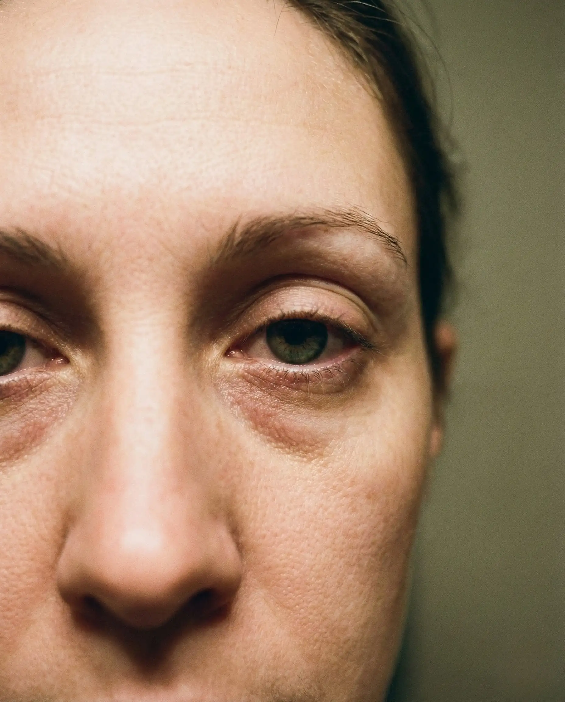 Close-up de rosto feminino evidenciando sulco lacrimal profundo (tear trough) com sombras escuras embaixo dos olhos antes do tratamento de preenchimento.