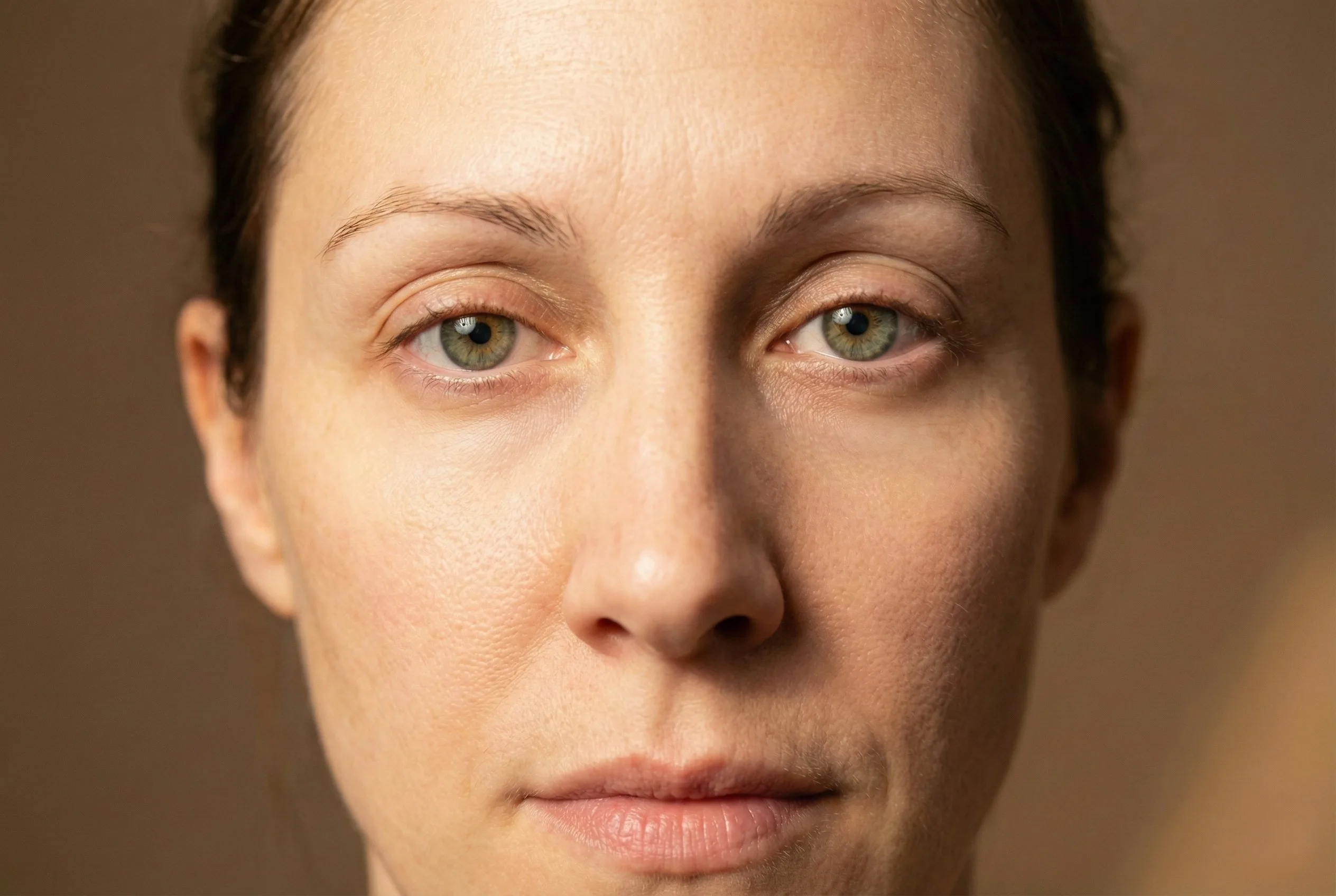 Mão com luva médica branca segurando a seringa estéril e a caixa do produto Teosyal PureSense Redensity II, o ácido hialurônico desenvolvido especificamente para preenchimento de olheiras.